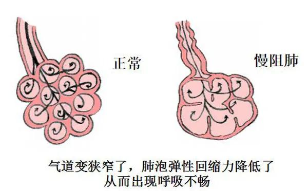 【疾病科普】慢性阻塞性肺病的认识误区