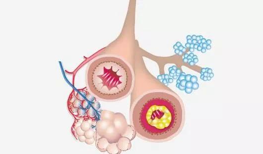 【疾病科普】慢性阻塞性肺病的认识误区