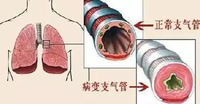 急性气管-支气管炎如何治疗？呼吸病医生帮你支招！ 