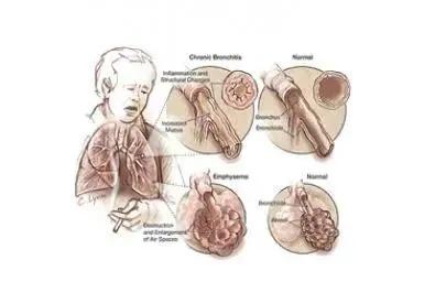 肺气肿有哪些征兆和症状，避开诱因好预防 