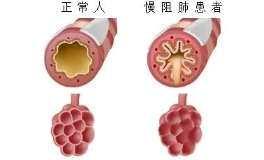 咳嗽、咳痰、呼吸困难？警惕慢阻肺！慢阻肺该如何防治?