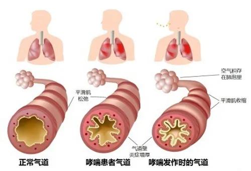 为什么支气管哮喘容易在夜间发作，有哪些原因你知道吗？