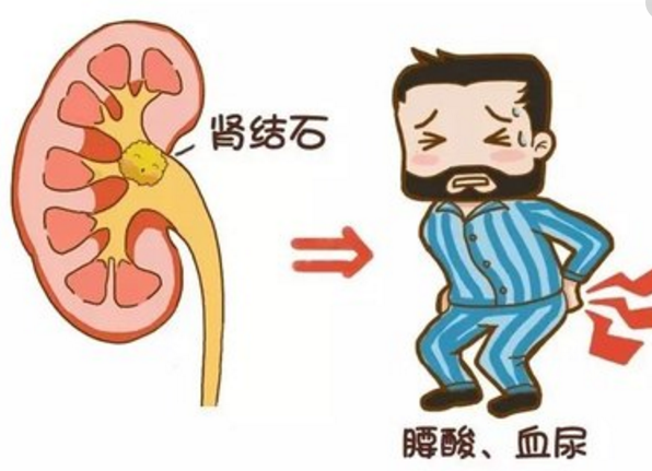 怎么预防肾结石 这5个好习惯一定不能忘