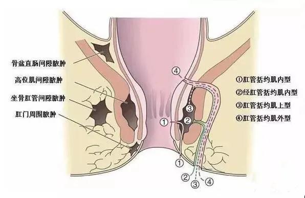 天气炎热 当心肛周脓肿！