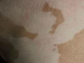 女性白癜风注意事项，女性患有白癜风需要注意哪些事项呢?