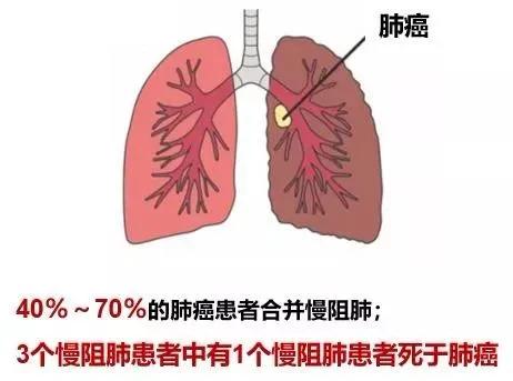 吸烟！反复咳痰！超过40岁！小心慢阻肺