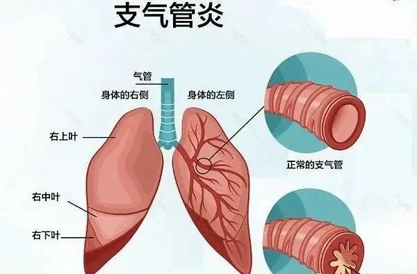 【疾病科普】支气管炎和哮喘有何区别，切勿混淆！