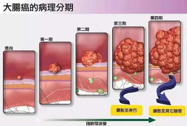 31岁漂亮女模特便血两个月，上网搜索以为是痔疮，没想到是癌症！