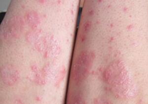 牛皮廯有可能正在侵扰您的皮肤