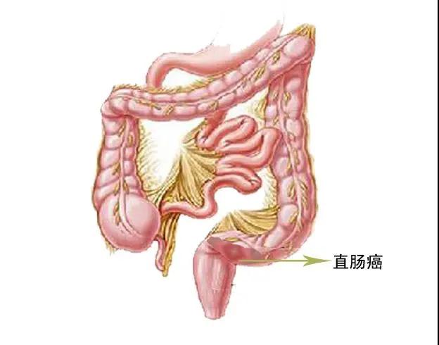 便血的原因，你知多少？