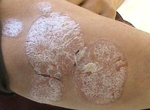 牛皮癣复发有哪些征兆？面对牛皮癣的复发，我们需要做些什么？