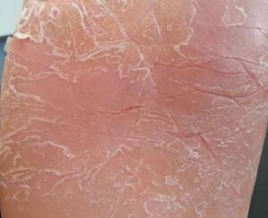 牛皮癣复发有哪些征兆？面对牛皮癣的复发，我们需要做些什么？