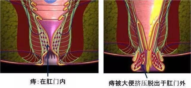 内痔和外痔, 哪个比较严重？