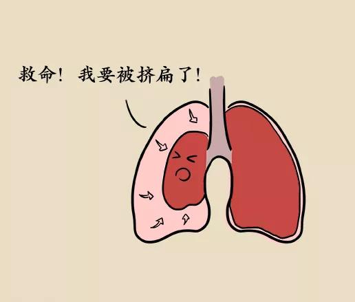 关于“肺部定时”——肺大泡，你不得不了解的事