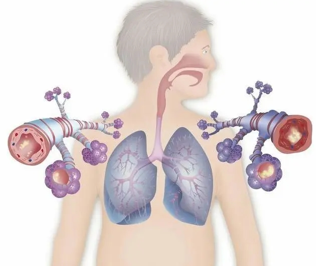 慢性支气管炎到晚期有何危害？如何尽早察觉？