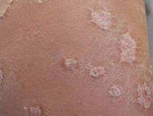 导致女性出现牛皮癣是什么原因呢?如何避免这种情况呢?