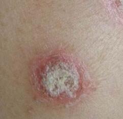 如何预防牛皮癣呢?应该做好哪些预防工作?