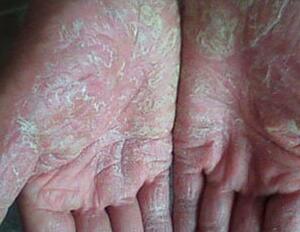 如何预防牛皮癣呢?应该做好哪些预防工作?