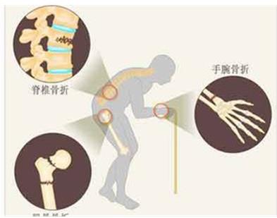 老年人该如何预防骨质疏松，一起看看吧