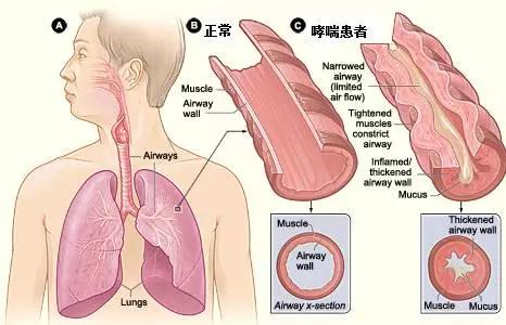 哮喘反反复复总是发作，患者如何做好自我防护？