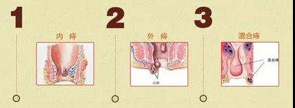 那些得了痔疮，却总好不了的概都长这样……