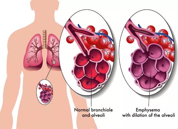 肺气肿如何治疗？排痰、排气是关键！ 