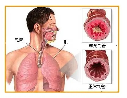 咳嗽、咳痰、咯血小心支气管扩张！严重可导致心衰~