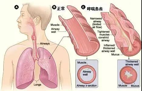 支气管炎和哮喘，症状相似分不清？别急，3点教你全面区分