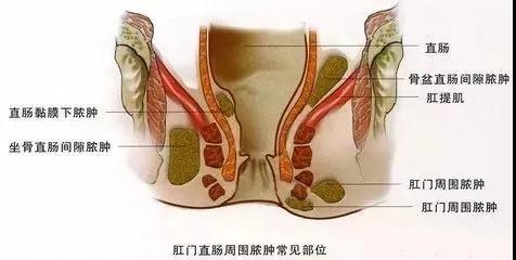 菊花一紧！听说痔疮会发展成直肠癌？