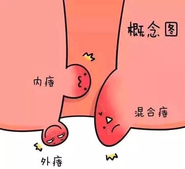 都是痔疮，为什么别人不疼你疼？