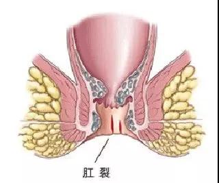 每次大便像拉玻璃碴子，是肛部裂开了吗？能自己愈合？