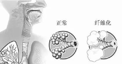 间质性肺炎的五大误区你一定要知道！建议收藏