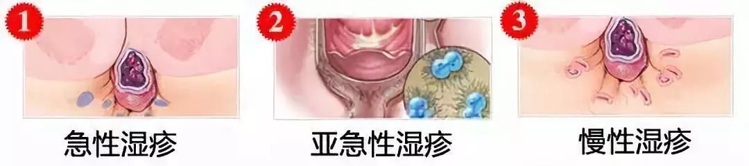 屁股潮湿、瘙痒?肛部处有红疙瘩?要警惕了!