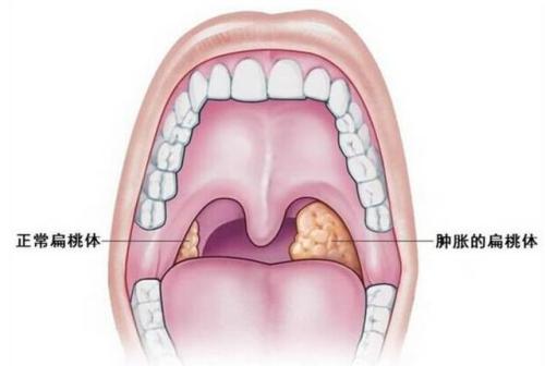 儿童扁桃体肥大可能是由细菌病毒引起的当我们身体抵抗细菌的能力下降