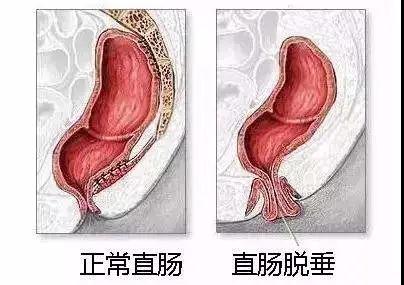 脱肛是个很角色！那脱肛可以自行恢复吗？