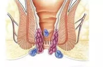 混合痔早期和晚期有什么不同？