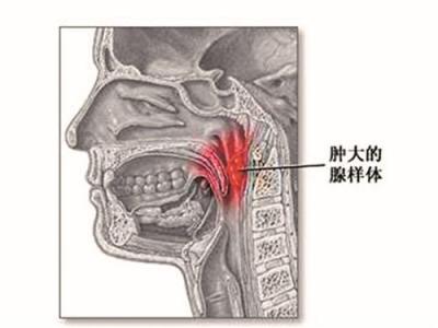 北京腺样体肥大那个医院好