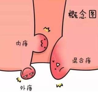 痔疮常疼出血会不会就癌变了