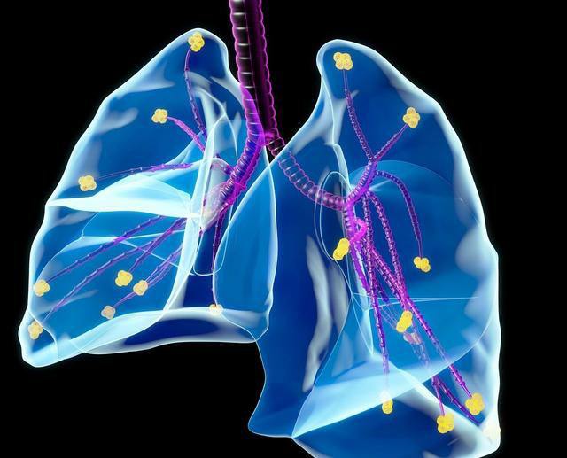 【疑问解答】肺大泡可以逆转吗？情况严重还会引发其他并发症？