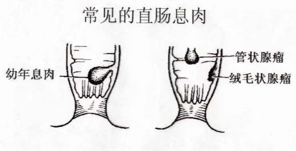 便血不疼常见于哪些疾病，你知道吗？