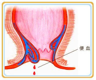 便血如何止？