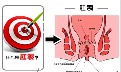 预防肛裂发生我们应该怎么做