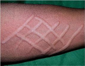 荨麻疹的危害:1,诱发其他疾病慢性荨麻疹发病如伴有消化道症状,会引起