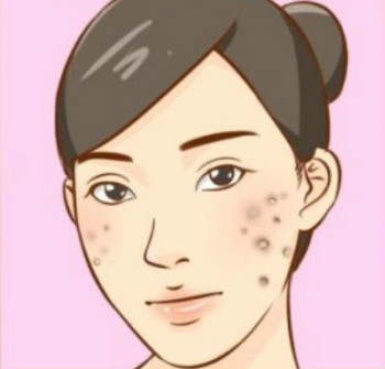 生活中如何预防痤疮?治疗痤疮有哪些误区?