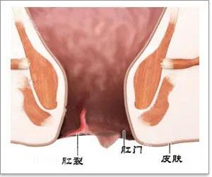 排便别太用力，肛裂可能会找上你