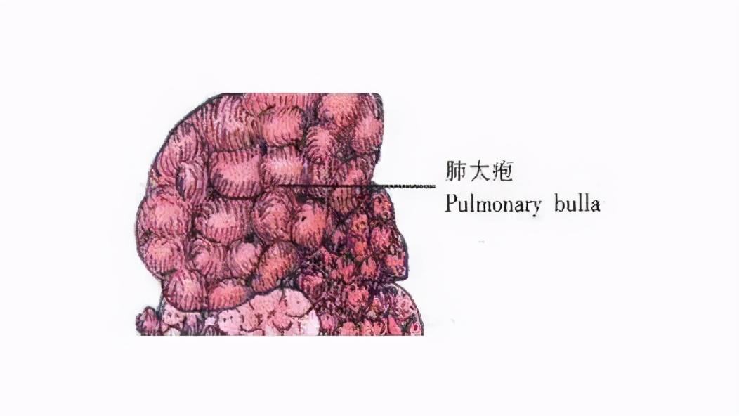 肺大泡的病因有哪些？有哪些类型？