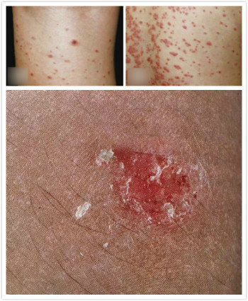 生活中如何预防皮肤疖病？