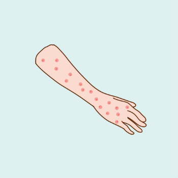 女性患上皮肤病-荨麻疹应该注意什么？