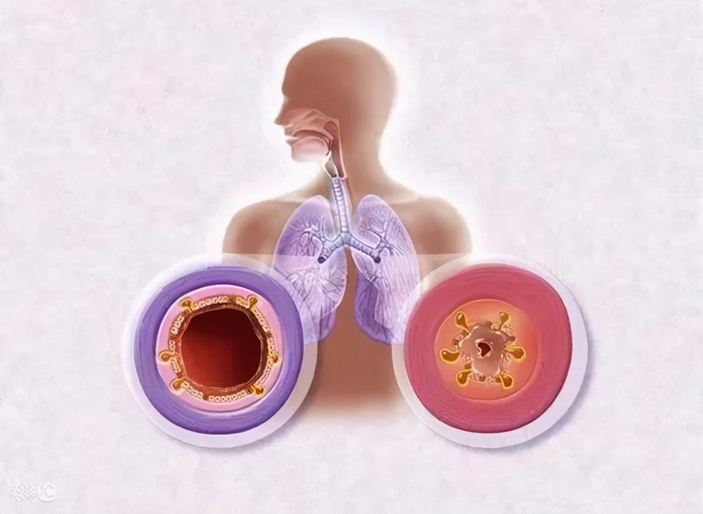 【健康科普】支气管炎与哮喘不要混淆，通过症状正确区分