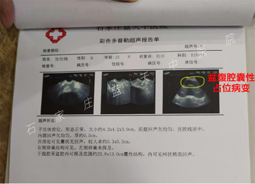 石家庄蓝天中医院：月经不调+异常出血→警惕卵巢巨大囊肿